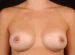 Breast Augmentation 410 - Case #5 After