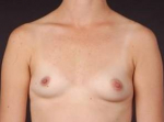 Breast Augmentation 410 - Case #6 Before