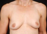 Breast Augmentation 410 - Case #7 Before