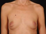 Breast Augmentation 410 - Case #8 Before