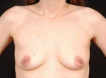 Breast Augmentation 410 - Case #9 Before
