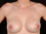 Breast Augmentation 410 - Case #9 After