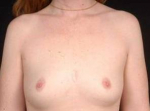 Breast Augmentation 410 - Case #11 Before