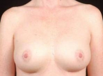 Breast Augmentation 410 - Case #11 After