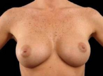 Breast Augmentation 410 - Case #12 After