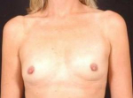 Breast Augmentation 410 - Case #13 Before