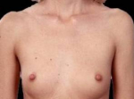Breast Augmentation 410 - Case #14 Before