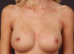 Breast Augmentation 410 - Case #14 After