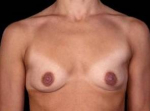 Breast Augmentation 410 - Case #16 Before