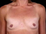 Breast Augmentation 410 - Case #17 Before