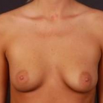 Breast Augmentation Saline - Case #1 Before