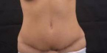 Abdominoplasty Revision - Case #2 Before