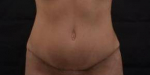 Abdominoplasty Revision - Case #2 After