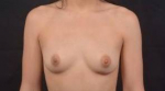 Breast Augmentation Silicone Gel - Case #75 Before