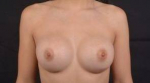 Breast Augmentation Silicone Gel - Case #75 After