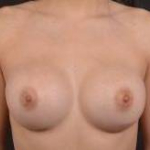 Breast Augmentation Silicone Gel - Case #75 After