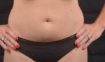 Abdominoplasty - Case #15A Before