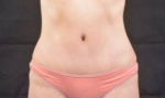 Abdominoplasty - Case #15A After
