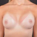 Breast Augmentation Silicone Gel - Case #74 After
