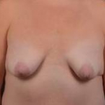 Breast Augmentation Silicone Gel - Case #67 Before