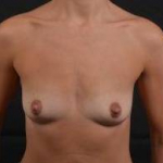Breast Augmentation Silicone Gel - Case #66 Before