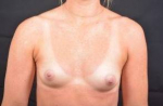 Breast Augmentation Silicone Gel - Case #61 Before
