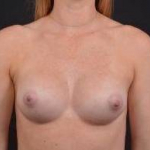 Breast Augmentation Silicone Gel - Case #61 After