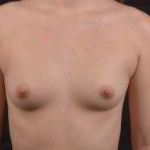 Breast Augmentation Silicone Gel - Case #59 Before