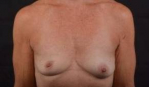 Breast Augmentation Silicone Gel - Case #58 Before