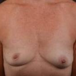 Breast Augmentation Silicone Gel - Case #58 Before