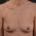 Breast Augmentation Silicone Gel - Case #56 Before