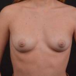 Breast Augmentation Silicone Gel - Case #55 Before