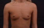Breast Augmentation Silicone Gel - Case #54 Before