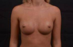 Breast Augmentation Silicone Gel - Case #54 After