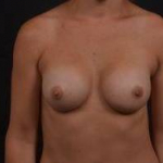 Breast Augmentation Silicone Gel - Case #53 After