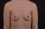 Breast Augmentation Silicone Gel - Case #51 Before