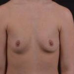 Breast Augmentation Silicone Gel - Case #51 Before