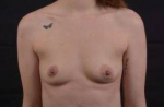 Breast Augmentation Silicone Gel - Case #50 Before