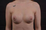 Breast Augmentation Silicone Gel - Case #50 After