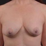 Breast Augmentation Silicone Gel - Case #48 Before