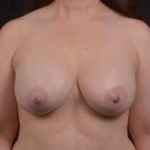Breast Augmentation Silicone Gel - Case #48 After