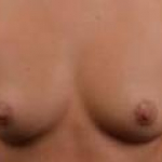 Breast Augmentation Silicone Gel - Case #47 Before