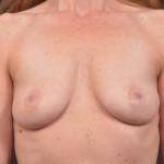 Breast Augmentation Silicone Gel - Case #46 Before