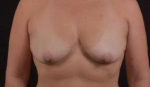 Breast Augmentation Silicone Gel - Case #44 Before