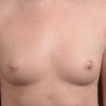 Breast Augmentation Silicone Gel - Case #43 Before