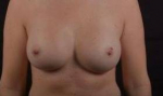 Breast Augmentation Silicone Gel - Case #43 After