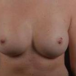 Breast Augmentation Silicone Gel - Case #43 After