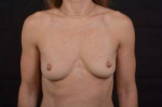 Breast Augmentation Silicone Gel - Case #42 Before