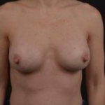 Breast Augmentation Silicone Gel - Case #42 After