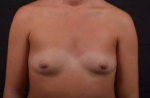 Breast Augmentation - Case #41 Before